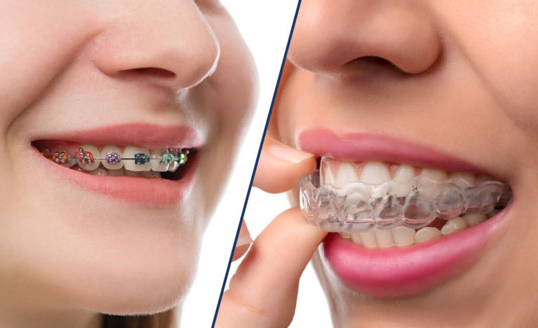 Braces and Invisalign