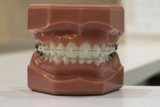 Braces and Invisalign orthodontics bedir dental clinic